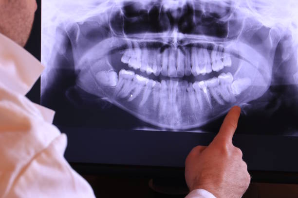 Best Emergency Dentist for Lost Fillings or Crowns in Keeseville, NY